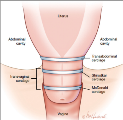 <p><strong>Cervical Insufficiency: Treatment</strong></p><p>-Cervical _________ + vaginal ___________ supplementation&nbsp;</p><ul><li><p>Cerclage → surgical procedure where a _______ is used to mechanically increase the tensile _________ of the cervix of patients with cervical insufficiency</p></li><li><p>Essentially stitching the cervix closed&nbsp;</p></li></ul><p>-Can be done ___________ or transabdominally&nbsp;</p><ul><li><p>Transvaginal usually attempted first&nbsp;</p></li><li><p>If not successful at preventing preterm labor, then transabdominal is done</p></li></ul><p></p>