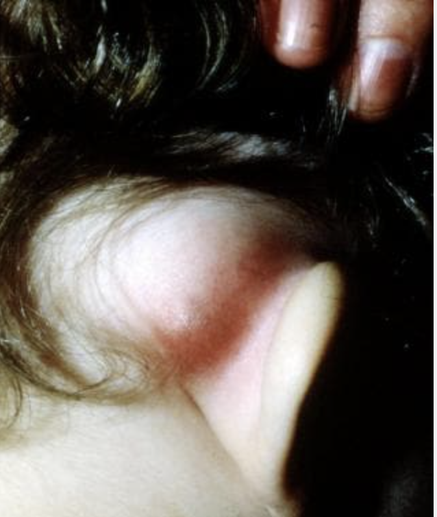 <p>78 y/o male presents to the ED for ear pain, he states that he is currently on antibiotics for an ear infection but he hasn’t been taking them. On physical exam you note postauricular erythema with tenderness and swelling - the auricle is protruding and there is no postauricular crease. What is your gameplan?</p>