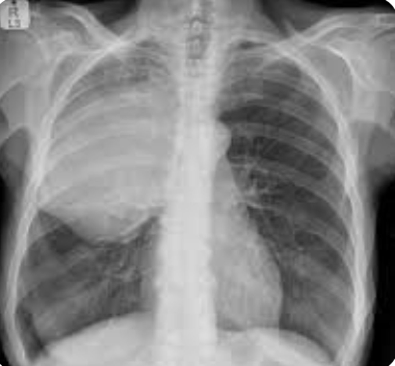 <p>What sign is present? Is this commonly seen?</p>