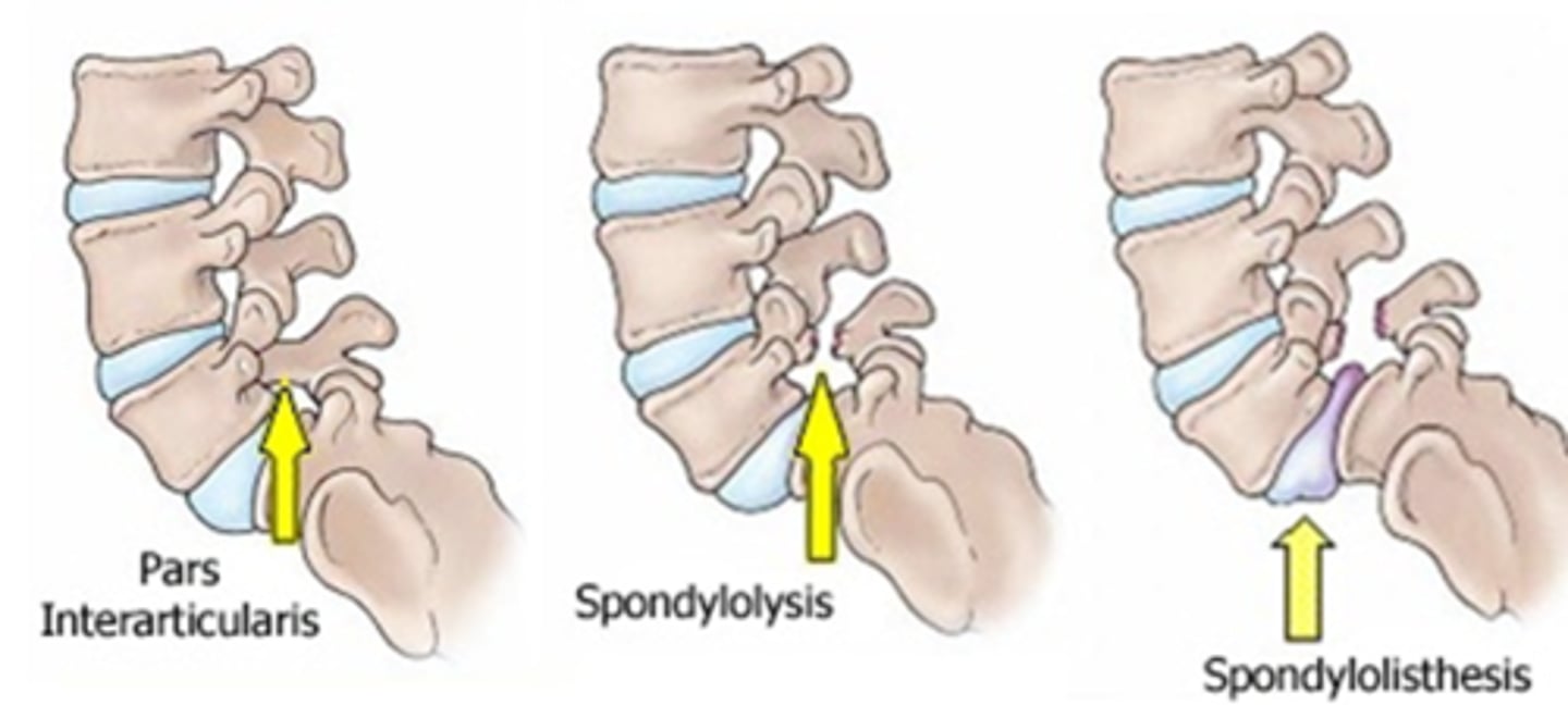 <p>spondylosis (stenosis)</p>