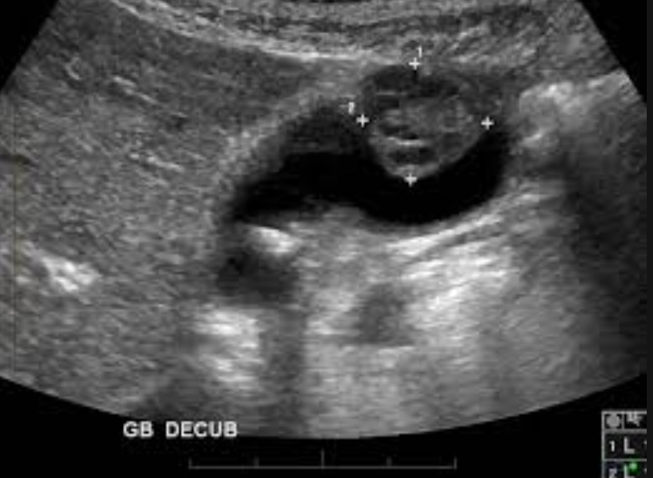 <p>Rare, aggressive malignancy; associated with stones or porcelain GB </p><p>Irregular, heterogeneous mass; wall thickening; polypod lesion&gt;1cm; may invade liver </p>