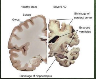 <p><strong>Alzheimer’s Dementia: Pathophysiology, pt 1</strong>&nbsp;</p><p>-__________ of cerebral cortex → temporal, frontal, parietal&nbsp;</p><p>-Enlarged ___________ → hydrocephalus ex vacuo&nbsp;</p>