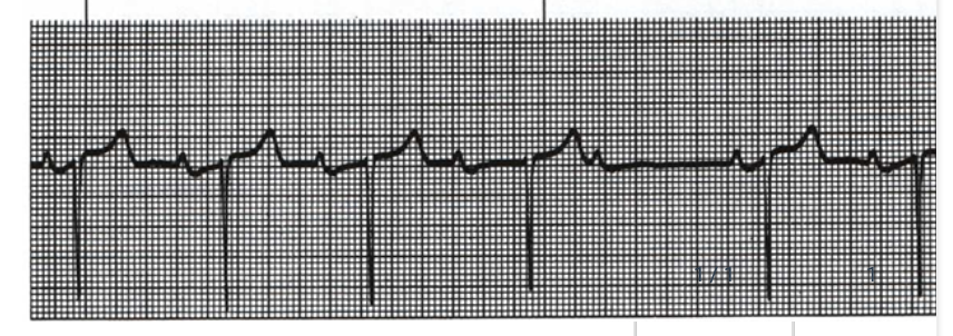 <p>name the rhythm</p><p>A. 2nd Degree AV block:</p><p class="p1">Wenkebach/Mobitz 1</p><p class="p2">B. Ventricular Fibrillation</p><p class="p2">C. 3rd Degree AV Block/Complete</p><p class="p2">Heart Block</p><p class="p2">D. Atrial Flutter</p>