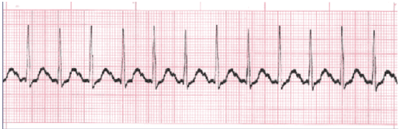<p>What is the rhythm?</p>