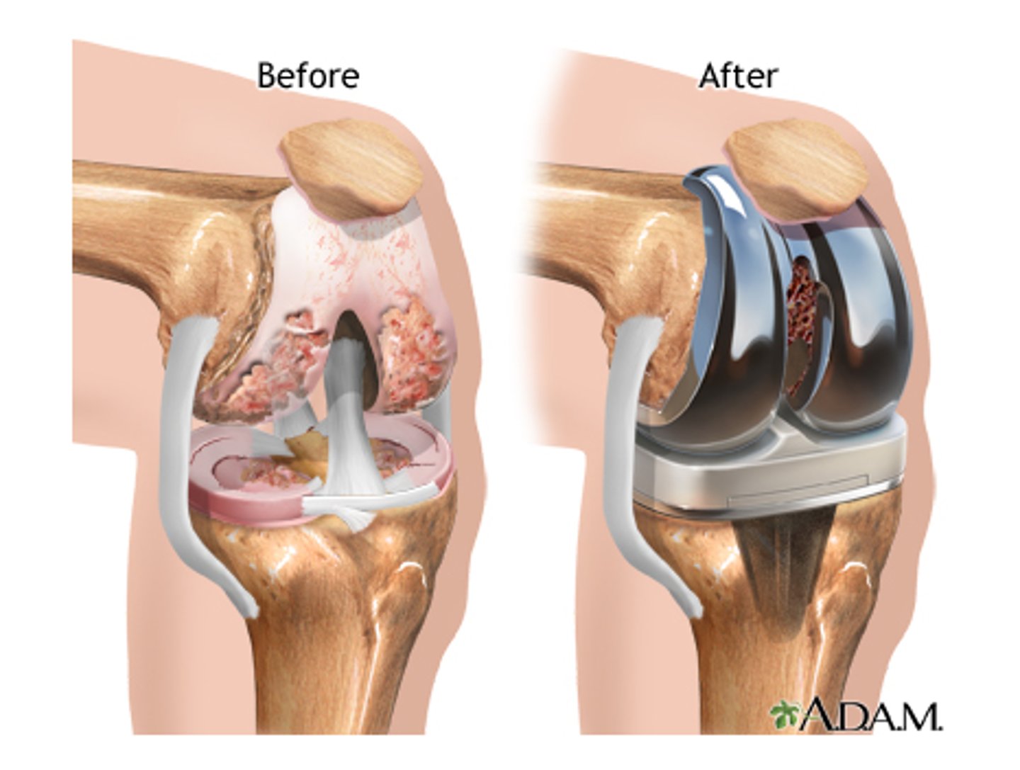 <p>surgical repair or replacement of a joint</p>
