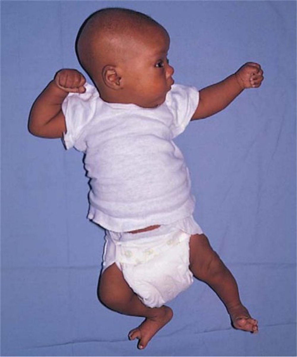 <p>turning the child's head to one side with jaw over shoulder; causes extension at arm and leg of face side and flexion of arm and leg of occipital side</p>