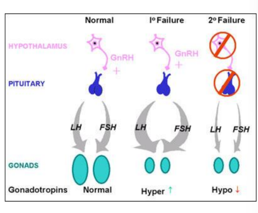 <ul><li><p>Diminshed functional activity of the gonads can result in:</p></li><li><p>Decreased biosynthesis of sex hormones — defective primary or secondary sexual development</p></li><li><p>impaired spermatogenesis/ovulation - partial or complete infertiltiy possible</p></li><li><p>congential or acquired</p></li></ul><p></p>