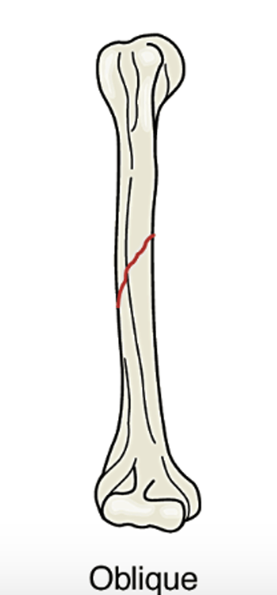<p>fracture occurs diagonally or at an oblique angle across th ebone</p>
