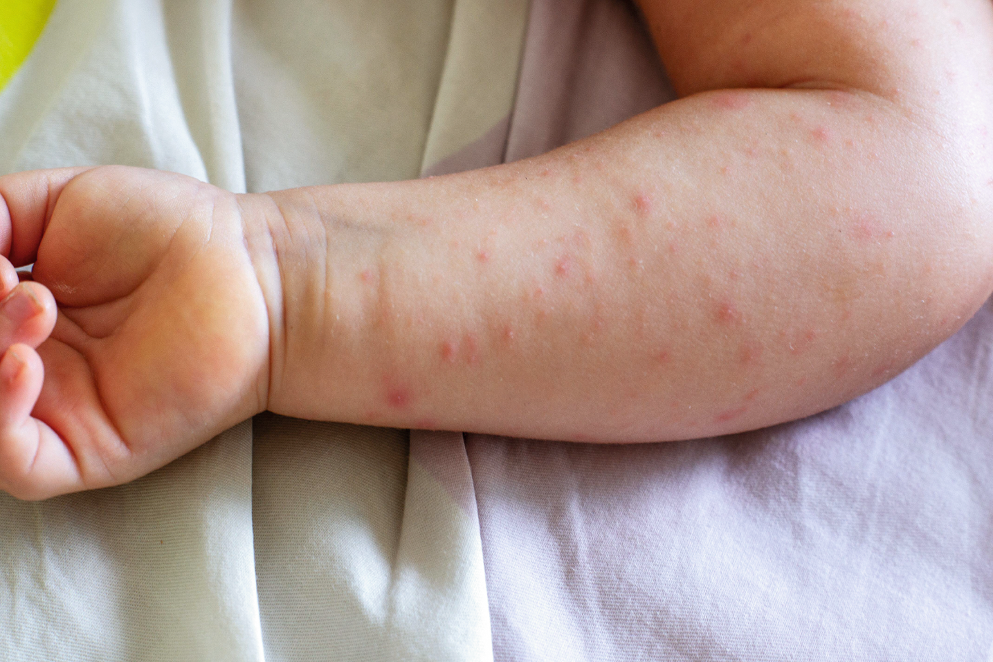 <p>What symptoms are typically present in patients with Wiskott Aldrich Syndrome at diagnosis?</p><p></p><p></p>