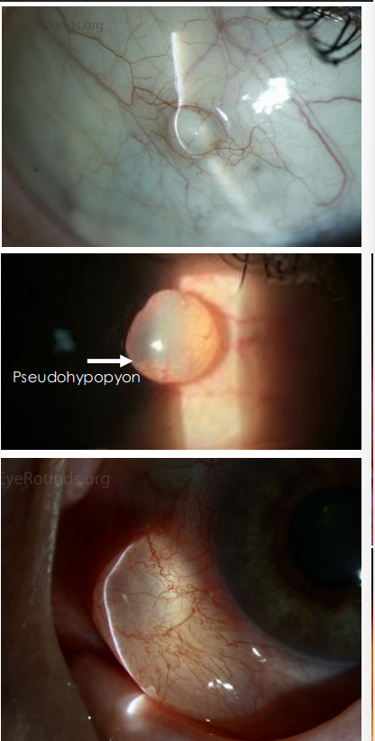 <ol><li><p>• Smooth, <strong><u>thin-walled cyst filled with clear serous fluid </u></strong></p></li><li><p>• Epithelial debris settles on the bottom forming “<strong><u>pseudohypopyon</u></strong>”</p></li></ol><p></p>