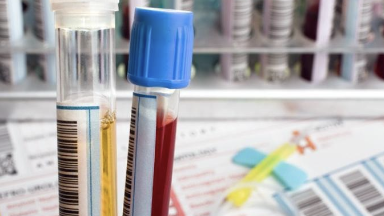 <p>1. CBC: platelets <40,000, mild anemia and hypoproteinemia</p><p>2. coagulation testing</p><p>-prolonged bleeding time</p><p>-abnormal clot retraction</p><p>-PT, PTT and fibrinogen within normal ranges</p><p>3. bone marrow biopsy (megakaryocytic and erythroid hyperplasia- regenerative response)</p>