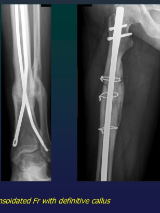 <p>CALLUS GENESIS</p><ul><li><p>Fibrino-proteic (1st 7 days)</p></li><li><p>Provisional fibrous (7-16 days)</p></li><li><p>Raw bone ( from day 16)</p></li><li><p>Definitive (6-12 maths)</p></li></ul><p>Rx</p><ul><li><p>Definitive: normal bone structure</p></li><li><p>Raw: NO structure</p><ul><li><p>visible after 20-60 days </p></li></ul></li></ul><p></p>