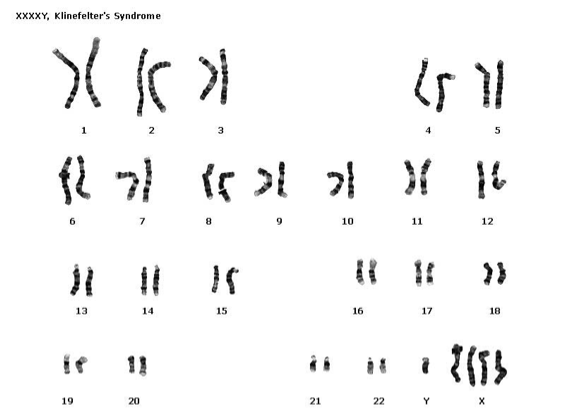 <p>Klinefelter’s syndrome</p>