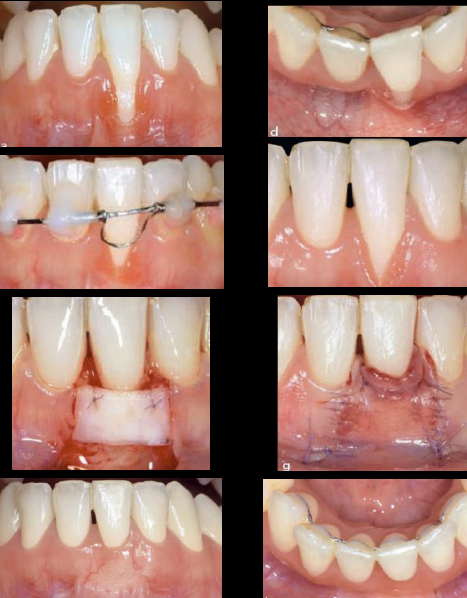 <p>Favorable: Tooth will be stabilized with comprehensive perio tx and PMT, loss of periodontal supporting tissues is unlikely</p><p>Questionable: Local/systemic factors may or may not be able to be controlled. periodontium can be stabilized with comprehensive perio treatment and maintained only is these factors are controlled, otherwise breakdown may occur</p><p>Unfavorable: Local and systemic factors cannot be controlled&gt; Perio breakdown is likely even with comprehensive periodontal tx and maintenance</p><p>Hopeless: Tooth must be extracted</p>