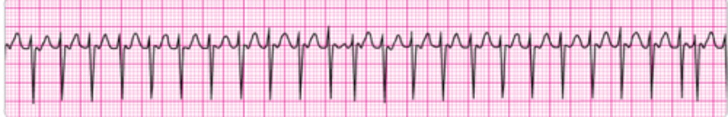 <p>Identify the rhythm.</p>