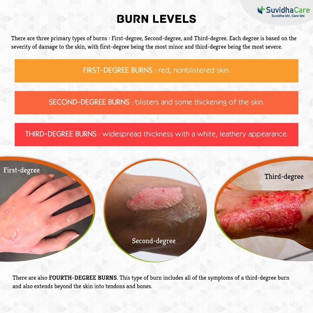 <p>Which type of burn damages the subcutaneous layer?</p>