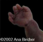 <ol><li><p>What is abnormal about this image?</p></li><li><p>This finding can be associated with what pathology?</p></li></ol><p></p>