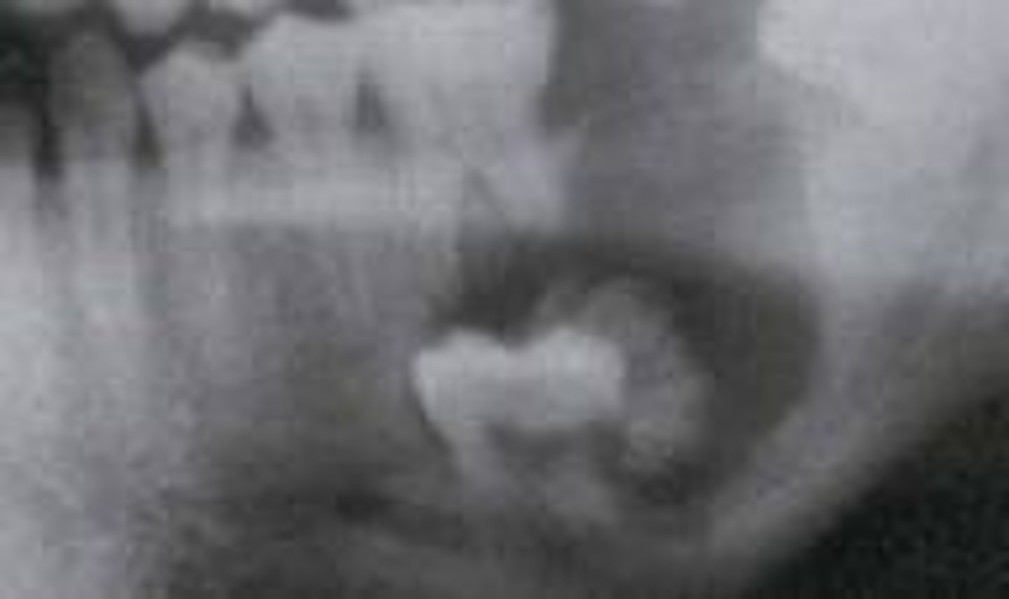 <p>mixed/RL</p><p>usually associated with unerupted tooth</p>