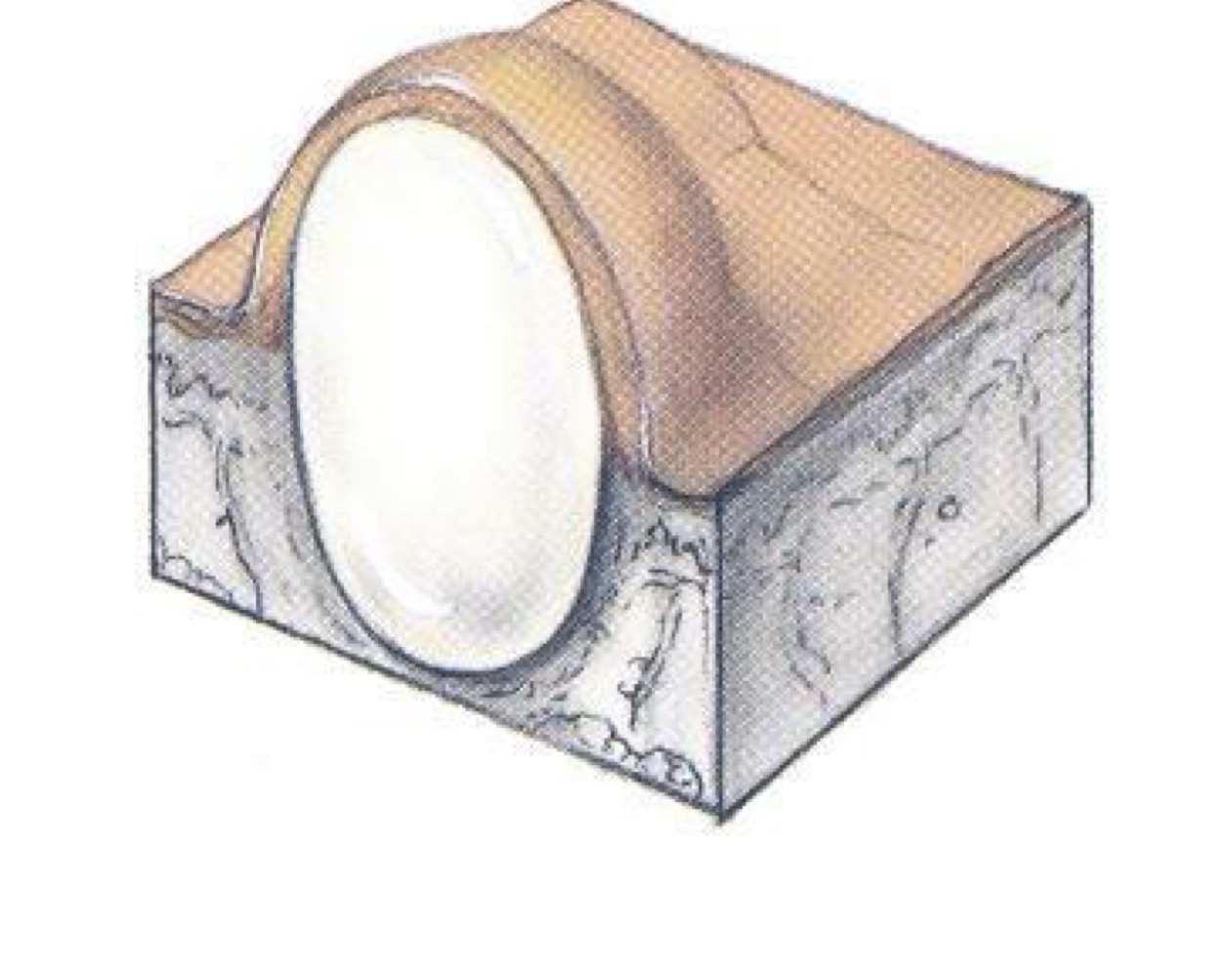 <p>what type of skin lesion is this? </p>