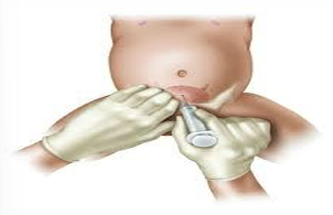 <p>What method of COLLECTION &amp; TRANSPORT OF URINE is this?</p>