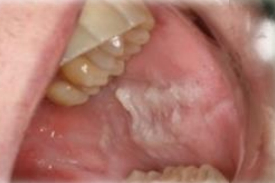 <p>Localized to diffuse white rough/shredded patches, adherent.</p><p class="has-focus">Asymptomatic</p><p class="has-focus is-empty">First and second decades</p><p class="has-focus">No gender bias</p><p class="has-focus is-empty"><strong>Found on:</strong></p><p class="has-focus">Mucosa adjacent to occlusal plane: Buccal, labial mucosa, lateral tongue, attached gingiva</p><p class="has-focus"></p><p class="has-focus is-empty">Ask: History of habits and ortho appliances?</p>