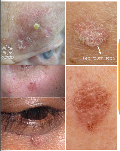 <ol><li><p>• Multiple, <strong><u>red to pink, rough and scaly patches</u></strong> of skin</p></li><li><p>• Dry, Flat, Immobile, plaques, that can become nodular</p></li><li><p>• Affected skin may have ”<strong><u>sandpaper</u></strong>” texture</p></li><li><p>• Maybe itchy</p></li><li><p><strong><u>• Precursor to Squamous Cell Carcinoma</u></strong></p></li></ol><p></p>