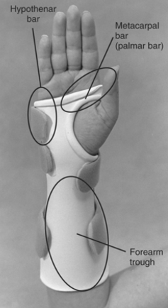 <p>Volar Wrist Splint fabrication includes clear way of DPC, thenar crease. Pop-out for prominent ulnar styloid. Wrist is in</p>