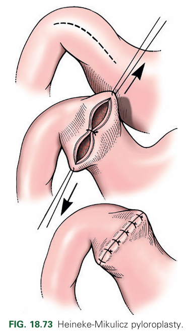 <p>A full-thickness longitudinal incision of the ventral pylorus closed transversely with an appositional interrupted pattern.</p>