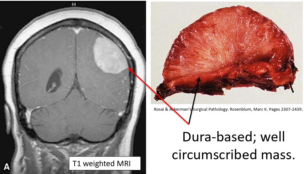 <p>Benign, non-infiltrating tumour frmed by extra-axial meningothelial cells</p><p>Diagnosis:</p><ul><li><p>CT shows dura-based, well-circumsised mass which does not invade underyling brain</p></li><li><p>Biopsy: meningothelial cells show whorled appearance with psamomma bodies</p></li></ul><p></p>