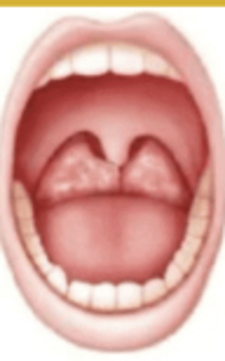 <p>which Brodsky grade:</p><p>Tonsils extend to midline</p>