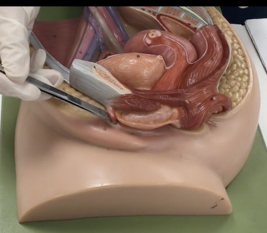 <p>Description: Erectile tissue anterior to external urethral orifice</p><p>Relationship: N/A</p>