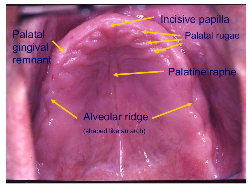 <p>PGR - can guide you to the best place to position the teeth</p>