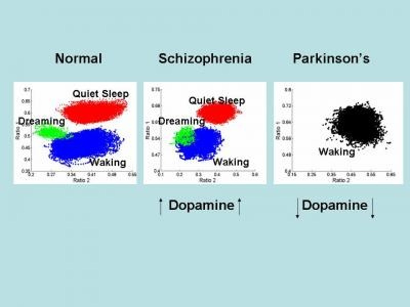 <p>(C) I and III only</p><p>Elevated Dopamine (or increased sensitivity to dopamine) has been theorized to cause symptoms of Schizophrenia.</p><p>Decrease Dopamine due to loss of dopaminergic neurons in the basal ganglia is associated with Parkinson's Disease.</p>