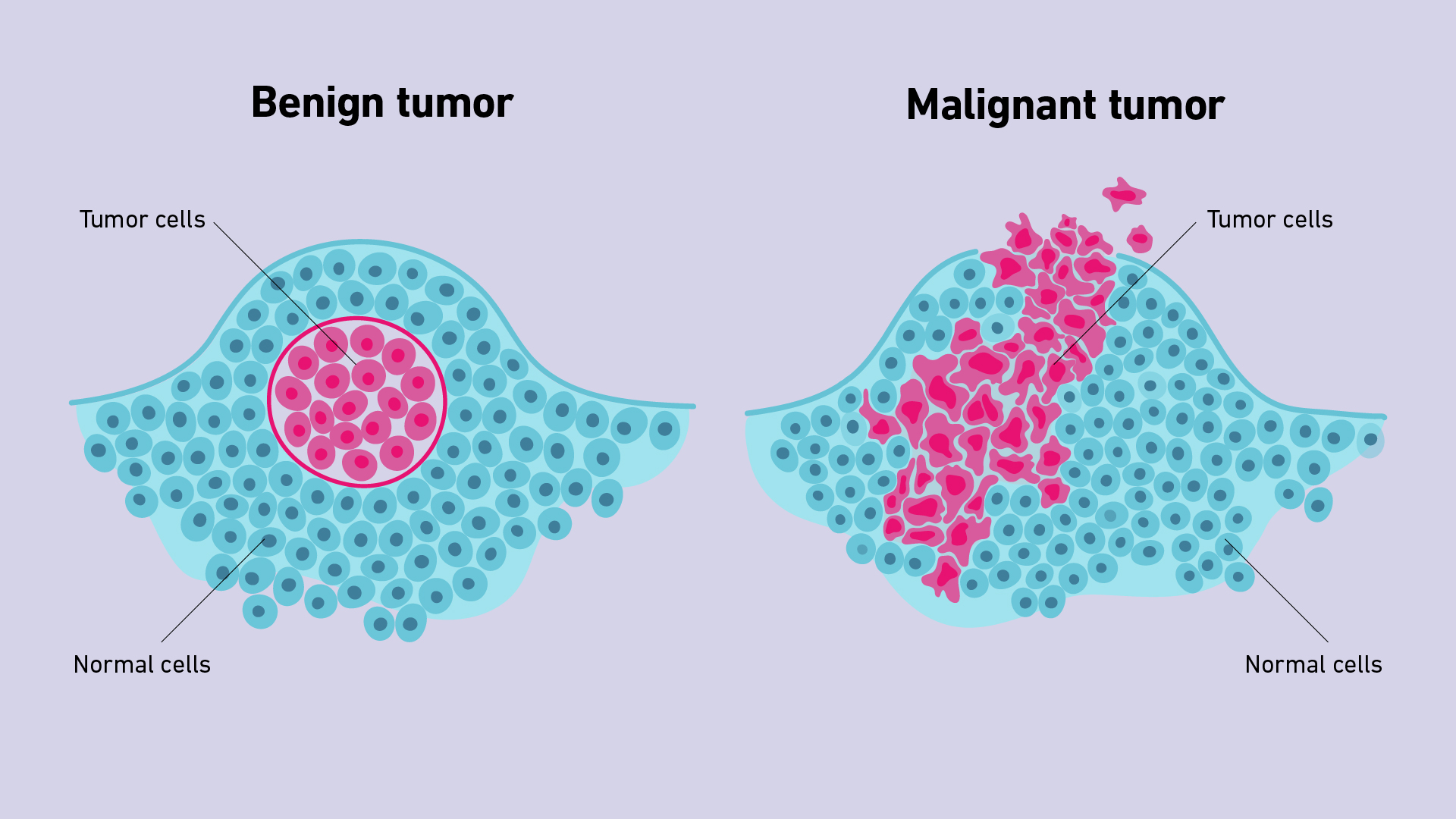 <ol><li><p>Generally more serious than benign tumors </p></li><li><p>Potentially <strong><em><u>life threatening </u></em></strong></p></li><li><p>Can be surgically removed, able to<strong><em><u> invade surrounding tissue/blood </u></em></strong></p></li><li><p>Can damage local and distant tissues/organs </p></li><li><p><span style="color: purple"><strong><em><u>Forms secondary tumors (metastases)</u></em></strong></span></p></li></ol><p></p>