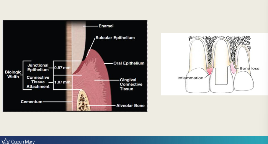 <p>Keep away from the biological width, kept within the depth of the sulcus, any margin going deeper than that would cause inflammation and bone loss damaging the biological width</p><p>Can use a retraction cord to get subgingival margin</p>