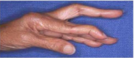 <p><strong>Static three-point orthosis </strong></p><p><strong>Function:</strong> </p><ul><li><p>Applies pressure at three specific points on a joint or limb to correct or support its position.</p></li><li><p>It’s used to correct <span style="color: red">boutonnière deformity</span> (the PIP joint is flexed and the DIP joint is hyperextended). The splint applies pressure over the PIP joint to hold it in extension, while additional pressure at the proximal phalanx prevents the PIP joint from bending. Another point of pressure at the distal phalanx maintains DIP joint extension, stopping it from overextending.</p></li></ul><p></p>