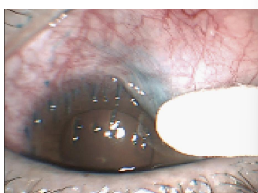 <p>Disease of the ocular surface characterized by bilateral chronic inflammation of the superior tarsal,<u> bulbar conjunctiva and cornea </u></p><p>• True etiology is unknown but multifactorial </p><p>• Can be associated with DED, <u>Sjogren’s</u>, RA, mechanical friction</p>