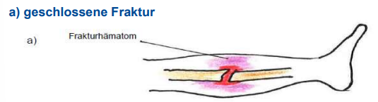 <p>Frakturen - Einteilung nach der Frakturform</p><ul><li><p>geschlossene Frakturen</p></li><li><p>offene Frakturen (durchstoßener Weichteilmantel)</p></li><li><p>inkomplette Frakturen (Fissur, Grünholzbruch)</p></li><li><p>komplette Frakturen</p></li><li><p>nicht dislozierte Frakturen</p></li><li><p>dislozierte Frakturen</p></li></ul><p></p>