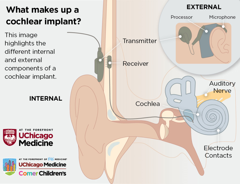 <p>Electronic devices that are used to give hearing to those who are profoundly deaf. The electrode is surgically inserted into the cochlea, a part of your inner ear. The implant stimulates the hearing nerve to provide sound signals directly to your brain. It helps people who have a  sensorineural hearing loss</p>