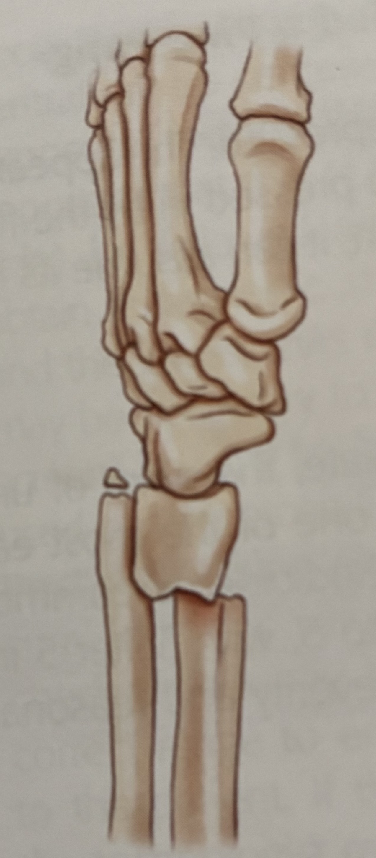 <p>What type of fracture is this?</p>