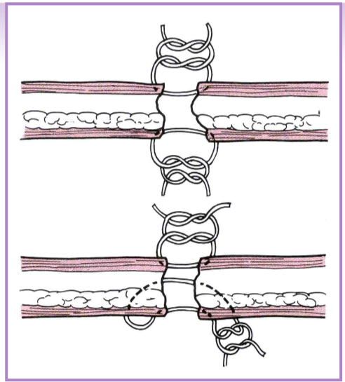 <ul><li><p>lacerations </p><ul><li><p>skin </p></li><li><p>skin + cartilage </p></li><li><p>skin + cartilage + skin </p></li></ul></li><li><p>use auricular cartilage as a template </p></li><li><p>partial thickness may be treated conservatively </p></li><li><p>marginal defects may be amputated </p></li></ul><p></p>