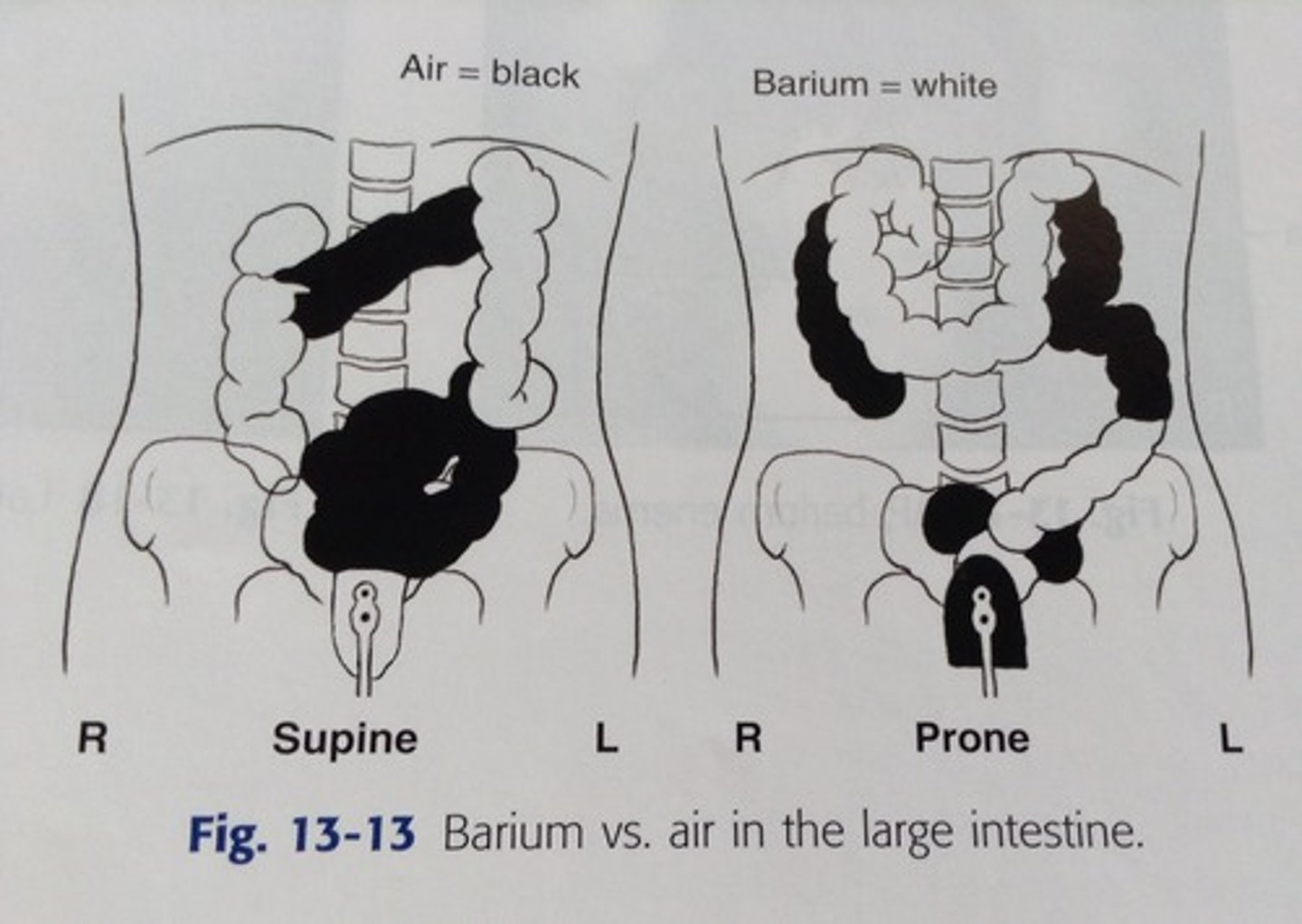 <p>Supine - barium in ascending and descending colon</p><p>Prone - barium in transverse and sigmoid colon</p><p>Right lateral decub - barium in right colic (hepatic) flexure and ascending colon, air in descending colon</p><p>Left lateral decub - barium in left colic (splenic) flexure and descending colon, air in ascending colon</p>