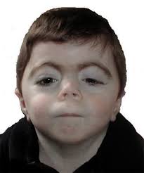 <p>Cejas muy espesas y pestañas largas. Anormalidades de los miembros o la falta de un dedo o más de las manos o de los pies (oligodactilia). Vello excesivo en el cuerpo. Epilepsia. Trastornos cardíacos y gastrointestinales. Baja talla. Discapacidad intelectual. Alteración del lenguaje a nivel expresivo y comprensivo.</p>