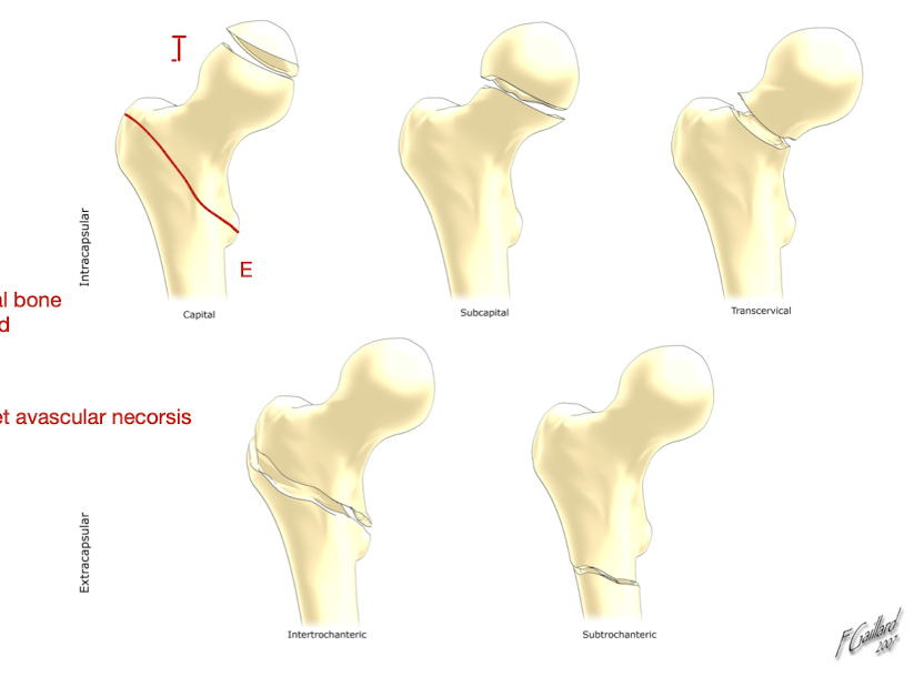 <p>Hip: Proximal Femur Fx</p><ul><li><p>Average Age:</p></li><li><p>Gender:</p></li><li><p>MOI:</p></li><li><p>2 Types:</p></li></ul><p></p><p></p>