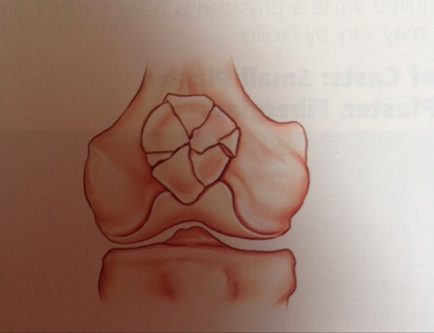 <p>fx lines radiate from a central point w/ a starlike appearance</p>