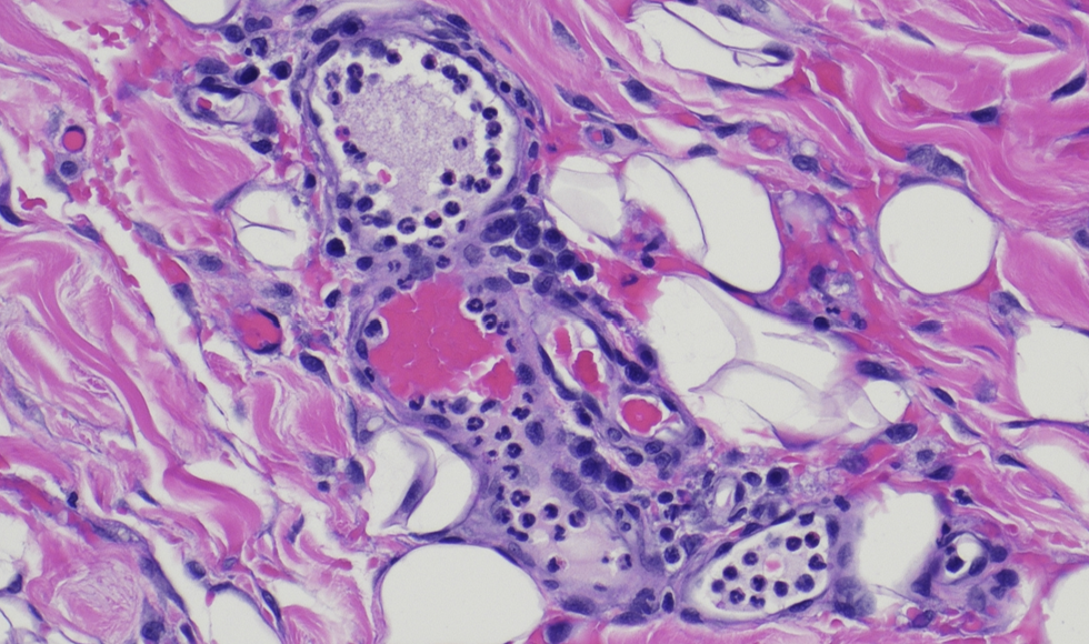 <p>loose transient adehsion between leukocytes and endothelium, mediated by surface expression of pre-formed selectins</p><p>rolls along endothelial lining</p>