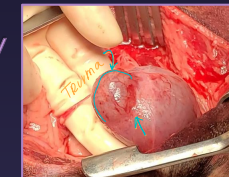 <ul><li><p><strong>Leak test:</strong> saline infusion w/ 22g needle while occluding neck</p></li><li><p><strong>Cystotomy:</strong> calculi, neoplasia, biopsy, polyp removal, ectopic ureter repair, cystopexy</p><ul><li><p>Exteriorize &amp; isolate bladder, place stay sutures at apex/body&nbsp;</p></li><li><p><strong><u>Incise ventrally</u></strong>, suction urine and lavage&nbsp;</p></li></ul></li></ul><ul><li><p><strong>Partial Cystectomy:</strong> neoplasia, necrotic/traumatized bladder, lesions in apex/body</p><ul><li><p><strong><u>NOT for trigone issues&nbsp;</u></strong></p></li></ul></li><li><p><strong>Cystopexy:</strong> perineal hernia, augment ureteral anastomosis</p><ul><li><p>open or laparoscopic/lap-assisted</p></li><li><p>Bladder sutured to <strong>lateral body wall</strong></p></li></ul></li></ul><ul><li><p><strong>Tube Cystostomy</strong></p><ul><li><p><span style="color: rgb(136, 136, 136);"><strong>Temp:</strong></span> Unstable patients&nbsp; w/ calculi obstruction, urethral trauma</p><ul><li><p>Diverts urine until definitive procedure</p></li></ul></li><li><p><span style="color: rgb(136, 136, 136);"><strong>Perm:</strong> </span>neurogenic bladder, urethral obstruction, neoplasia</p></li></ul></li></ul><img src="https://knowt-user-attachments.s3.amazonaws.com/209d47a1-c0f0-4436-8ab0-e5f5db227dac.png" data-width="25%" data-align="center"><p></p>