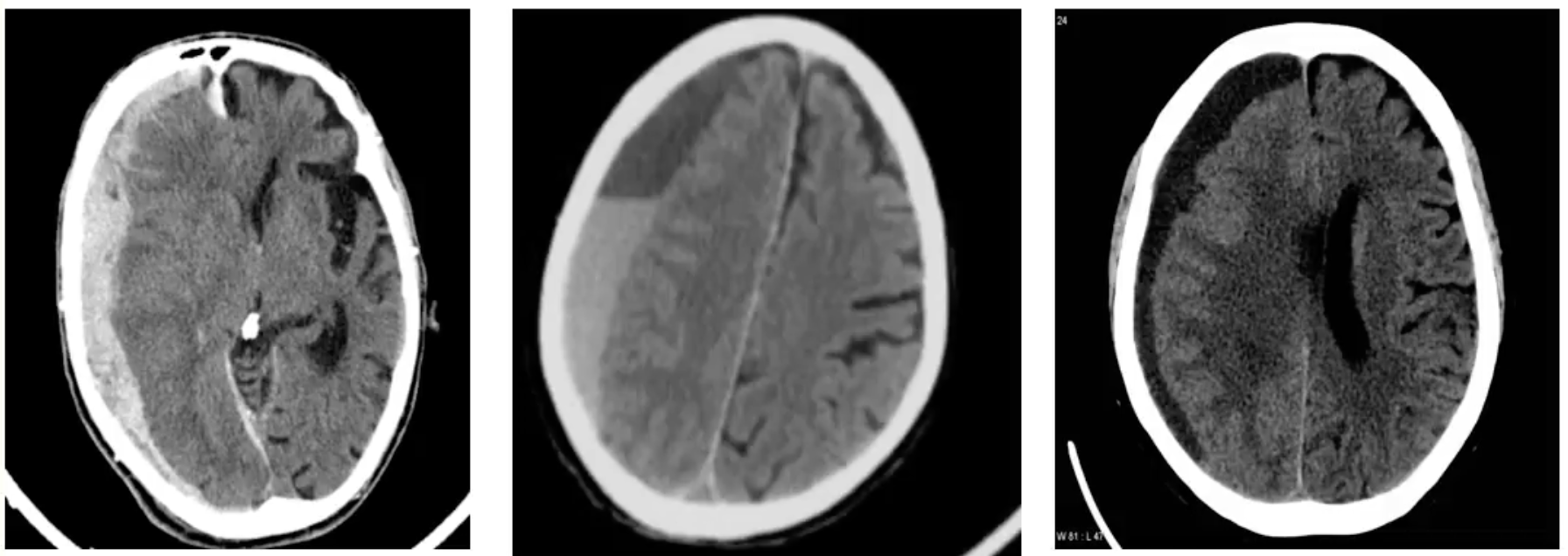 <ul><li><p><strong>agudos</strong>: < 3 dias → hipertenso em TC</p></li><li><p><strong>subagudos</strong>: 3 dias - 3 semanas → isodenso (= tecido cerebral)</p></li><li><p><strong>crónicos</strong>: >3 semanas → hipodenso</p></li></ul><p></p>