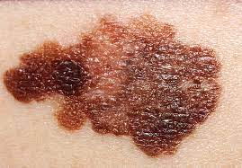 <ul><li><p>A cancer in melanocytes, or pigment-producing cells, in the skin</p></li><li><p>Usually appears as an irregular brown spot or changing mole</p></li><li><p>Can spread to other areas of the body, or metastasize</p></li><li><p>Can arise from normal skin or from a mole, which has turned bad</p></li><li><p>If caught early, is usually curable</p></li><li><p>If it spreads to other parts of the body, it can result in death</p></li></ul>