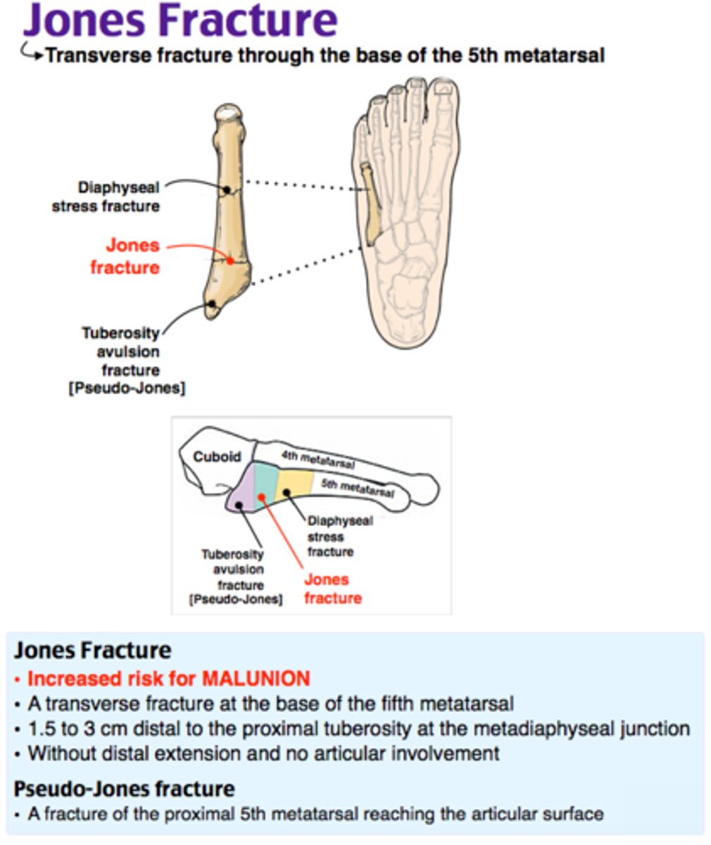 <p>fracture of the base of the 5th metatarsal</p><p>- occur in a vascular "watershed" area</p><p>- much more likely to produce a delayed union or nonunion due to the vascular anatomy of the area</p><p>- DOES NOT EXTEND INTO THE JOINT</p>